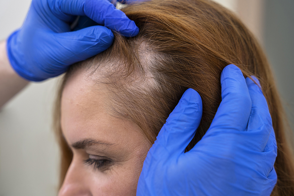 woman-getting-hair-graft-for-hair-loss-treatment