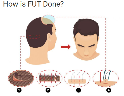 Hair transplant specialist Miami clinic